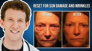 RESET for Sun Damage with Dr. Adam Scheiner | Marilyn's Testimonial