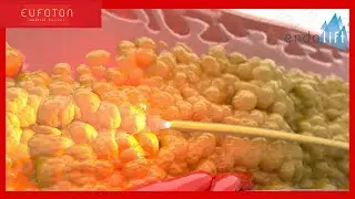 EndoliftX®: the laser evolution of lifting [Eufoton®]