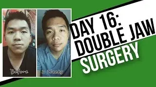 Day 16: Post Double Jaw Surgery