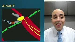 SVT - Supraventricular Tachycardia For Patients