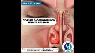 Вазомоторный ринит - лечение лазером.