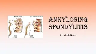 Ankylosing spondylitis - signs and symptoms, Schober test, Faber test, imaging, treatment