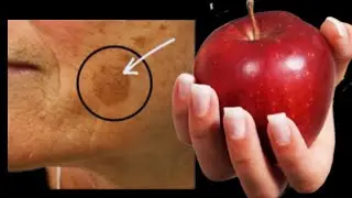 Wipe face blemishes with 100 years old recipe! 1 apple and not a single speck!