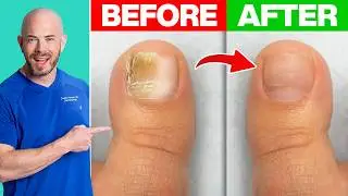 How to Treat Toenail Fungus - Derm Recommends
