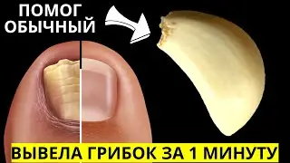 ПРОСТО НАТИРАЮ Ногти Чесноком! Как Я МОМЕНТАЛЬНО растворил Грибок на ногтях За 10 Минут!