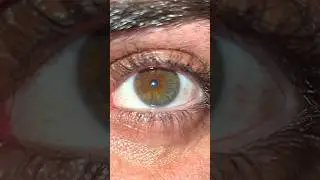Eye Heterochromia - Green & Brown