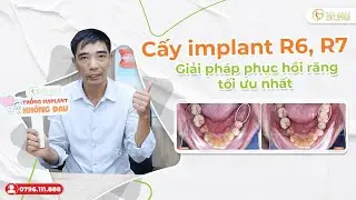 Trồng răng implant 