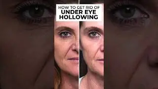 Get rid of under eye bags + hollowing with ezGEL #ezgel #ezgelprf #undereyebags #undereyefiller