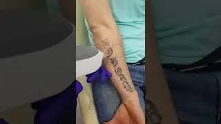 Удаление тату в клинике Асклепион