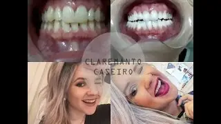 CLAREAMENTO CASEIRO (COM DENTISTA)