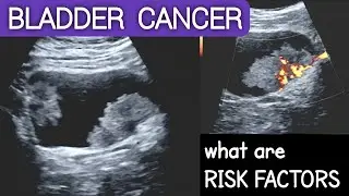 BLADDER CANCER | Ultrasound | What are Risk Factors ?