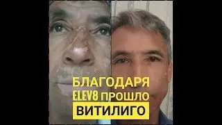 Как избавиться от Витилиго