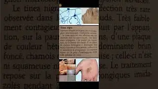 Tinea nigra