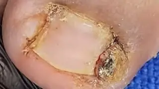 Malaking kuko nakatago sa gilid at napakamaga
