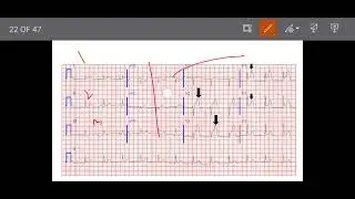 ECG|| Electrocardiogram || easiest explanation of ECG abnormalities