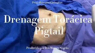 Drenagem de Tórax- Pigtail
