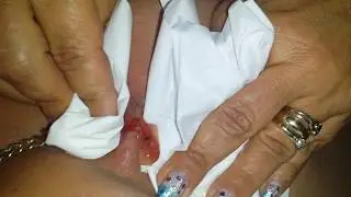 the volcanic cyst infection
