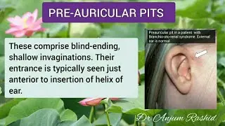Preauricular Pit Causes - Five Possibilities To Consider | Preauricular Pits Reasons