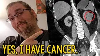 Yes, I Have Cancer.