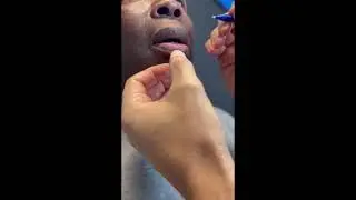 Dr. Cangello Demonstrates the Bikini Technique for Lip Reduction