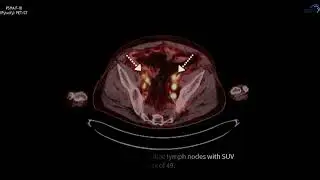 PSMA PET/CT F-18 Case 12