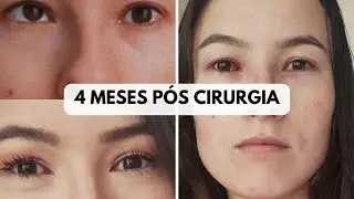 ESTRABISMO | RESULTADO DA CIRURGIA + VALOR