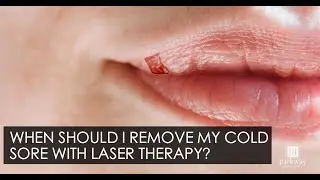 When Should I Remove My Cold Sore with Laser Therapy