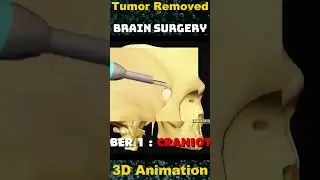 Brain Surgery: Removing Growth for Improved Health