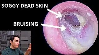 Non-infectious Otitis Externa (Fluid Retention with Stuck Hearing Aid)