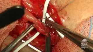 THE MOUNT SINAI SURGICAL FILM ATLAS: Arteriovenous Fistula