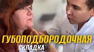 ГУБОПОДБОРОДОЧНАЯ СКЛАДКА - КАК УБРАТЬ | особенности на примере