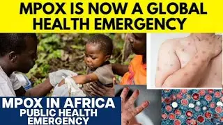 ALERT! New PANDEMIC is Spreading Across The World | MPOX Virus Explained ✍️✍️