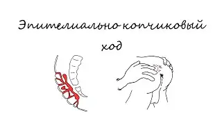 Эпителиально копчиковый ход I пилонидальная киста I ЭКХ