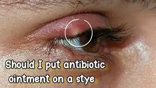 Should I put antibiotic ointment on a stye