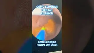 Como eliminar piedras del riñón 