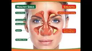 Sinusitis |साइनोसाइटिस के कारन सर दर्द |(हिंदी में  )| Medishala