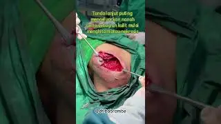 Gangrene of Breast #gangrene #breast #breastabscess