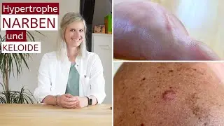 [4K] Hypertrophe Narben und Keloide | Vorbeugung | Tipps | Behandlung