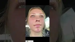 Beard Impetigo