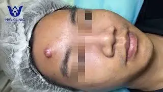 MỤN VIÊM TỤ CẦU SIÊU TO TRÊN TRÁN