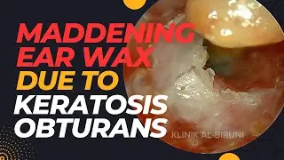 MADDENING Ear Wax Removal Due To Keratosis Obturans