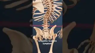 Idiopathic Scoliosis Symptoms