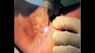 Phlebology - Transdermic Treatment Blue Violet Teleangectasias - Teleangectasie LASEmaR 800