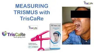 Measuring and Grading Trismus with TrisCaRe.  Dr. Pawan Gupta ICanCaRe