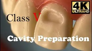 Class V Cavity preparation