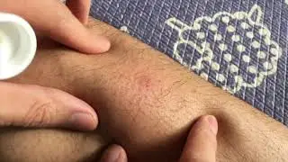 Bug Bite Thing! Does it actually work?