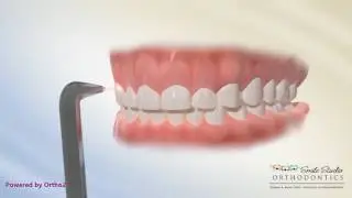 Laser Gingivectomy