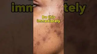 2 steps to reduce acne scars