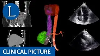 Renal cancer with tumour thrombus