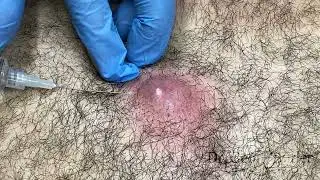 Removal of infected cyst from chest